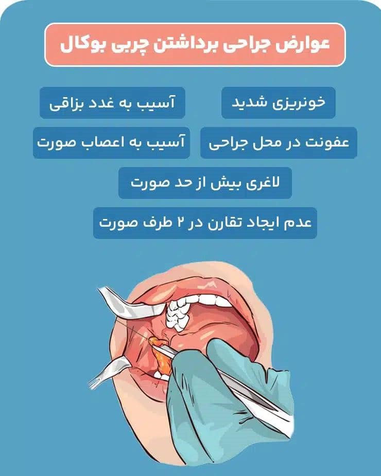 آیا عمل بوکال فت (بوکات) تصمیم درستی است؟