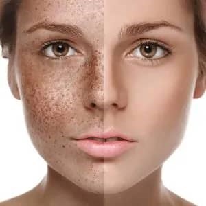 بهترین روش‌های درمان لک صورت: از کرم تا لیزر